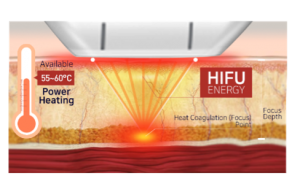 hautstraffung thermo coagulation points