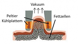 Kryolipolyse-Behandlung mit 3D-Ultimate Pro