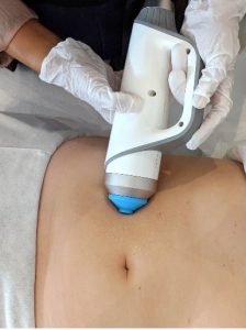 Stoßwelle Behandlung mit 3D-Ultimate Pro