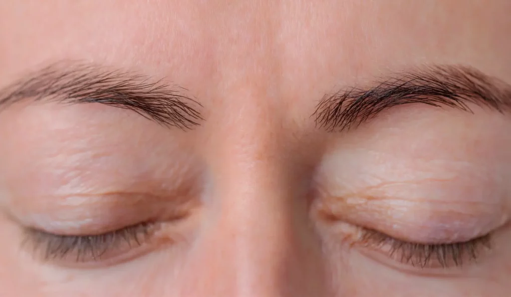 Gentlo Silkro - Microneedling Nachher