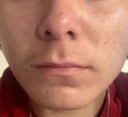 ADVATx Akne Narben Nachher