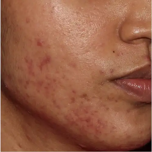 ADVATx Akne Narben Vorher