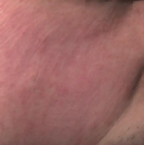 ADVATx Vascular Nachher