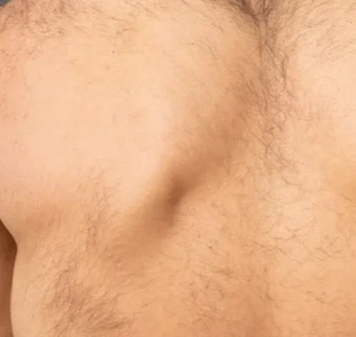 Enride pro - Haarentfernung Vorher