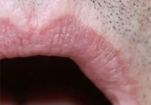 ADVATx Lippenrandanggiom Nachher